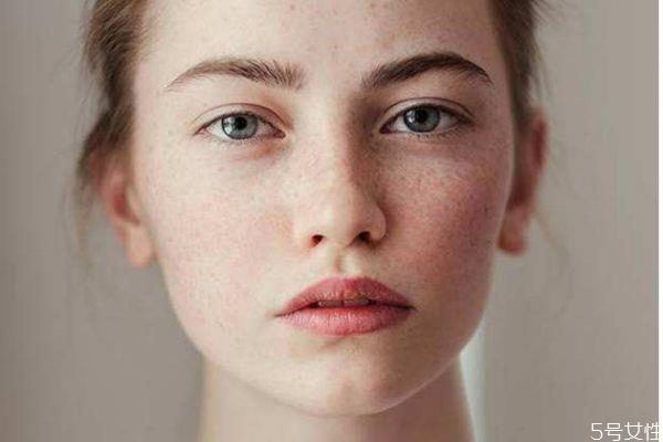 如何淡化雀斑呢 淡化雀斑的方法有什么呢 如何淡化雀斑呢 淡化雀斑的方法有什么呢