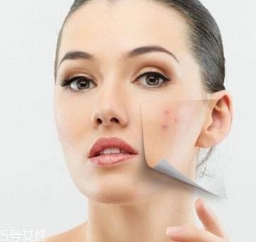 痘痘肌怎么补水 痘痘肌适合用的乳液推荐 痘痘肌怎么补水 痘痘肌适合用的乳液推荐