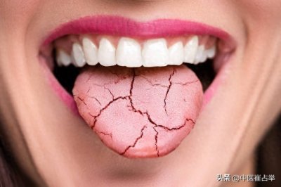 ​舌头中间有裂纹，是“大病征兆”？