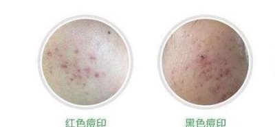 ​痘坑痘印能自己修复吗(痘印可以自己修复吗)